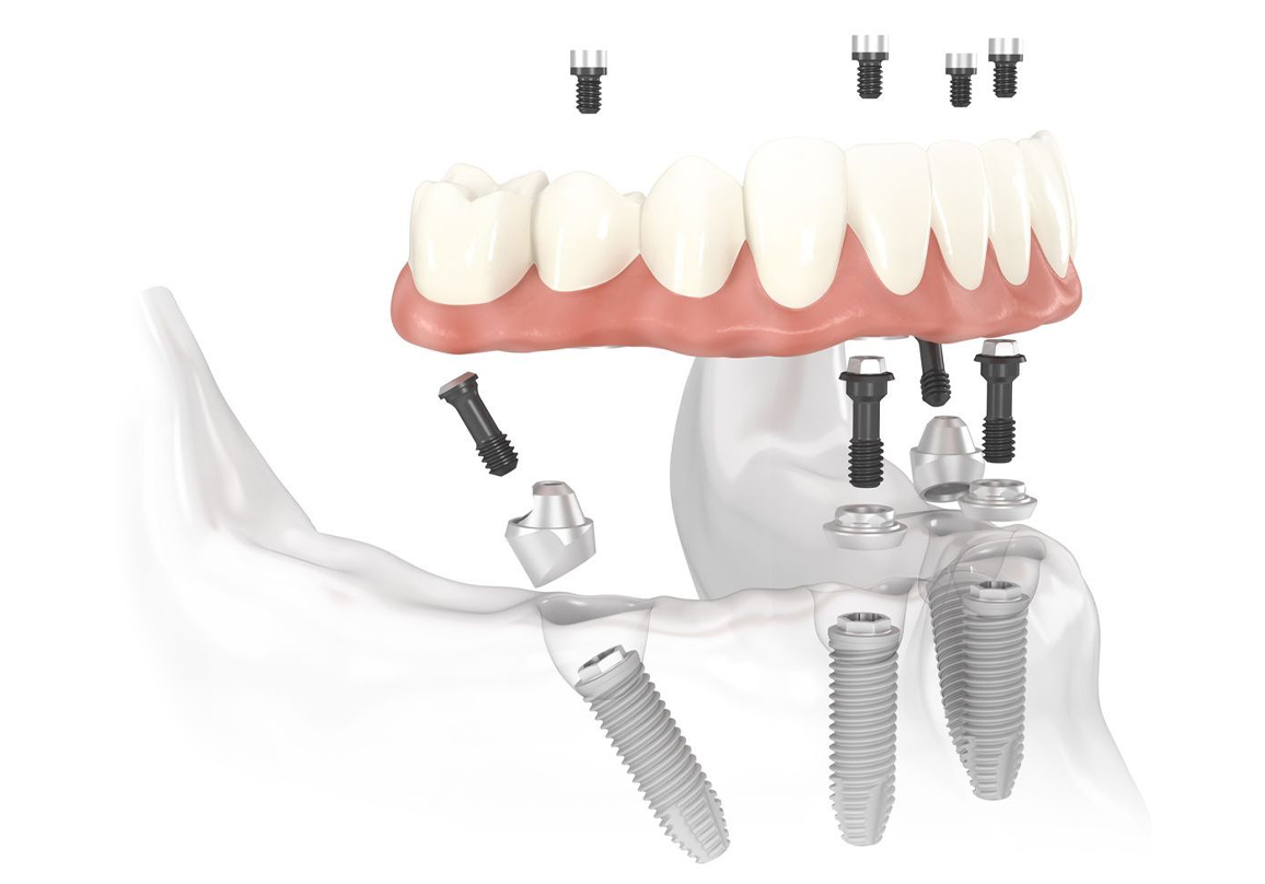 Implants Dentaires Souss Dentistic