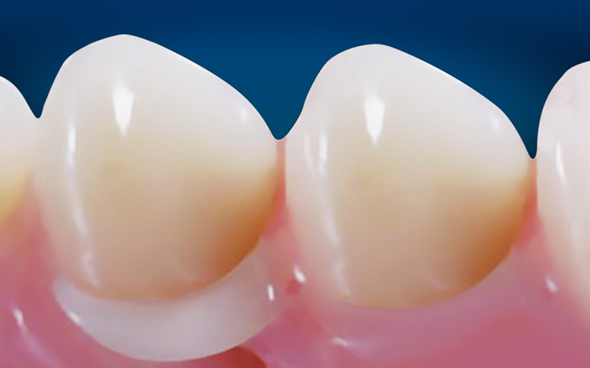 Prothèses Amovibles au Maroc