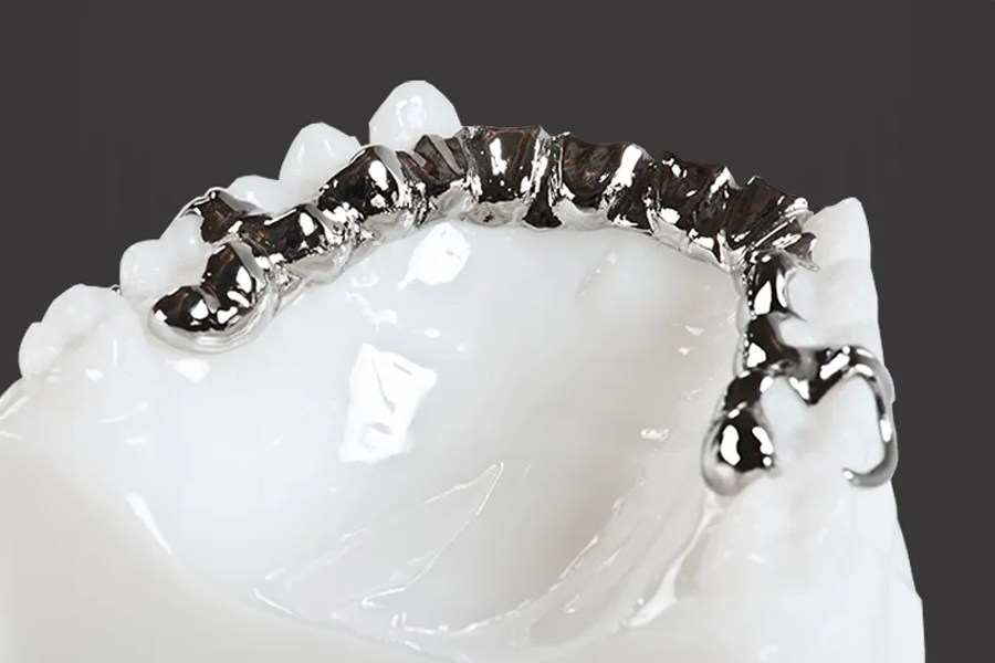 Prothèses Amovibles à Armature Métallique
