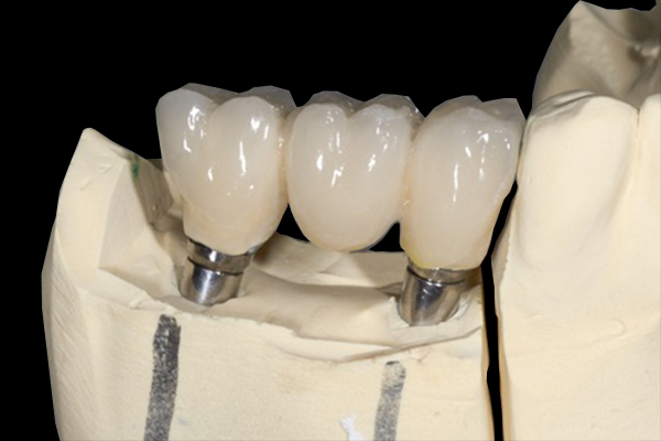 Dentier agadir Maroc