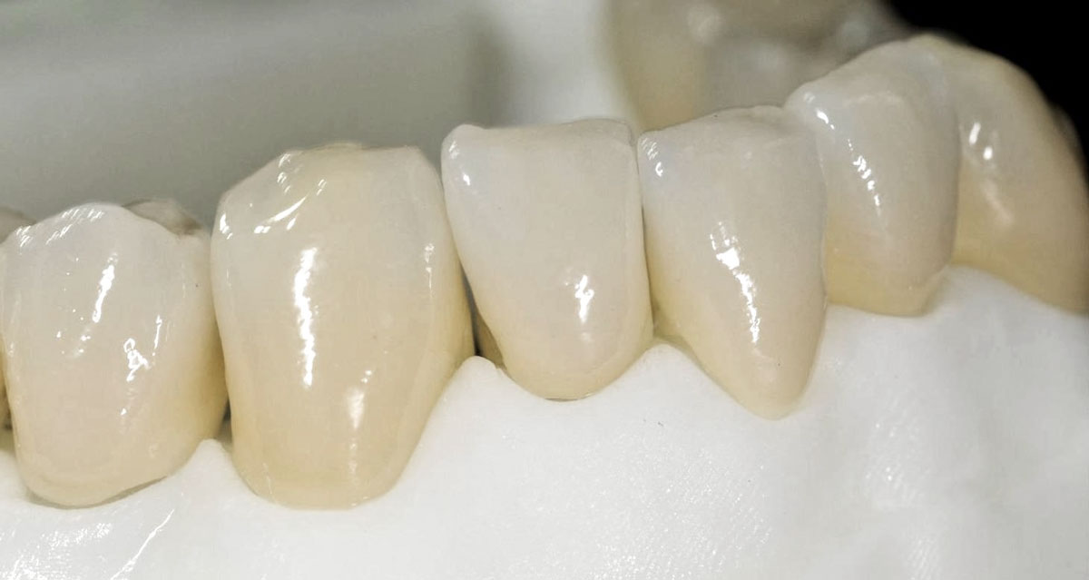 Zircones Monolithiques Souss Dentistic